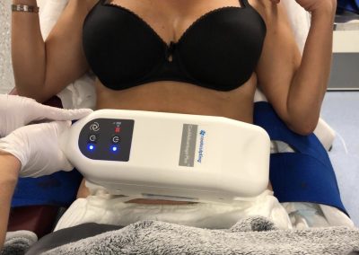 CoolSculpting